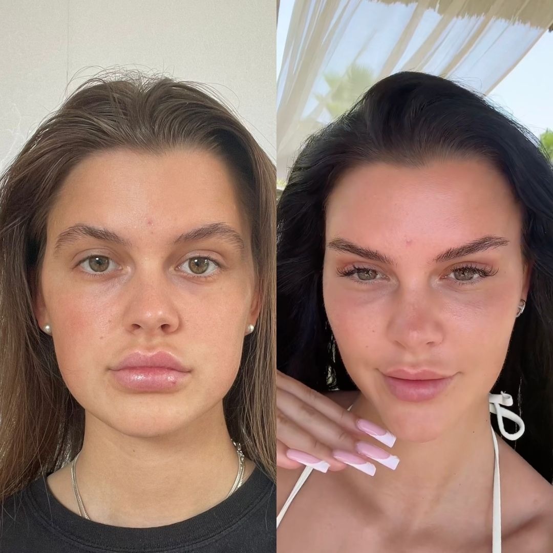 FACIAL SURGERIES